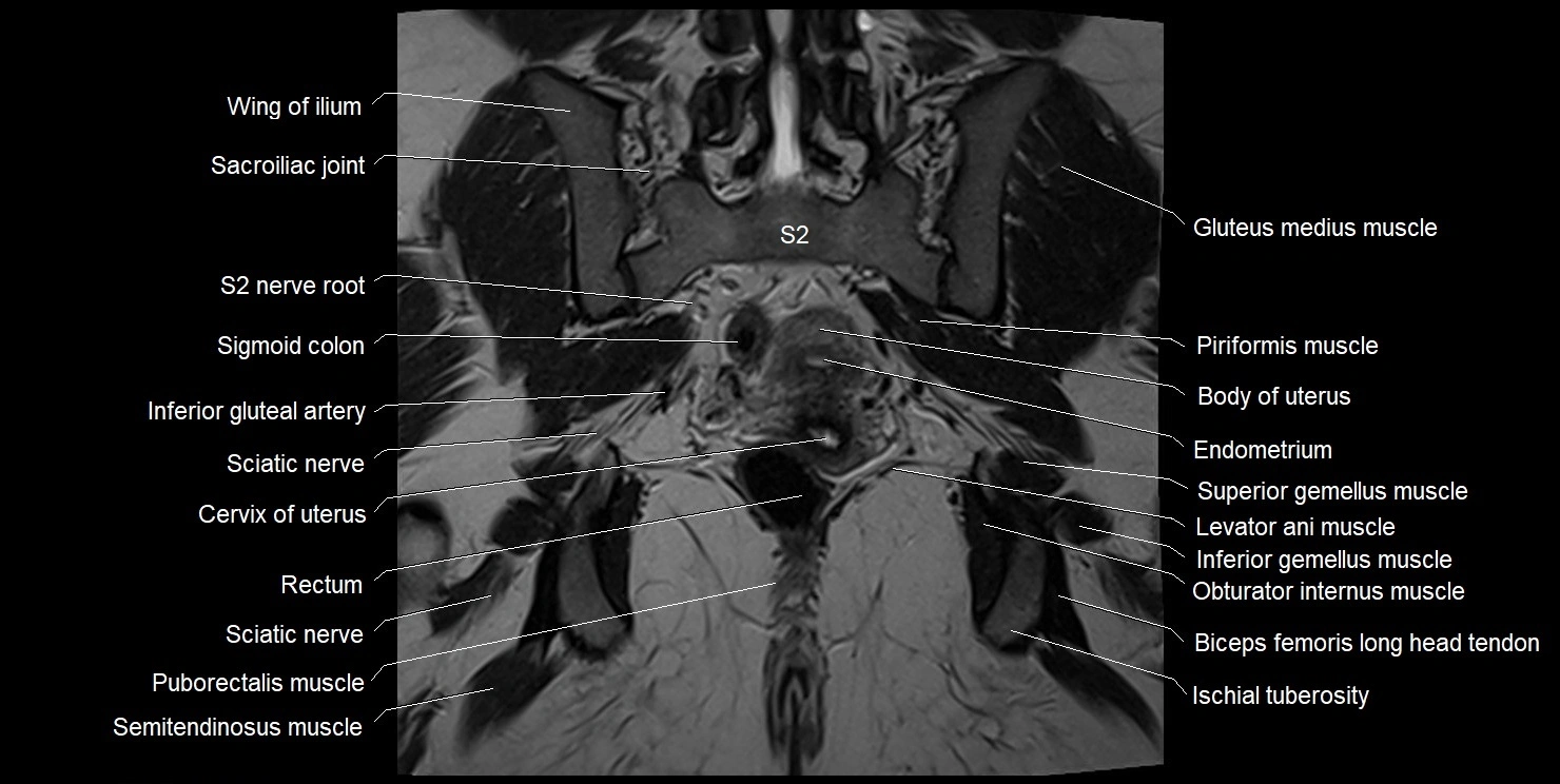 female pelvis coronal cross sectional anatomy image 26.webp